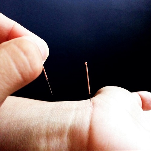 acupuncture durban amrawat 500x500 1